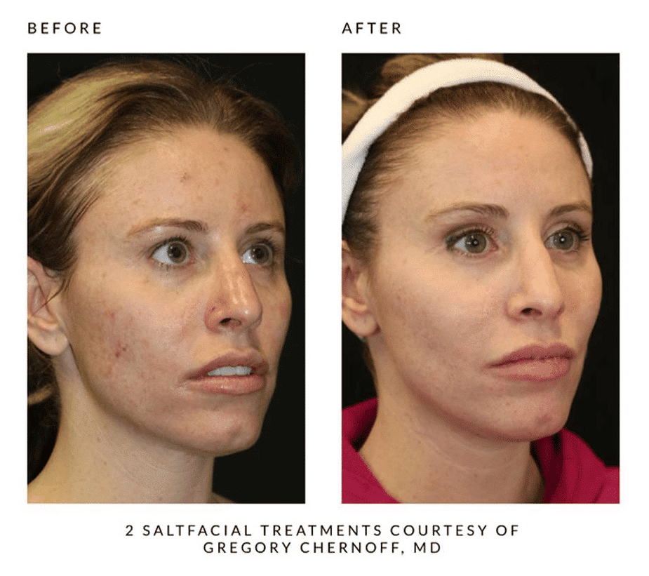Woman's before and after results from salt facial treatment at Revenge MD.