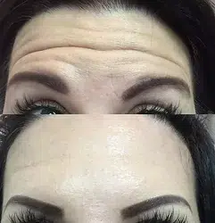 Forehead before and after Botox treatment, a service offered at Revenge MD in Las Vegas and Reno, NV.