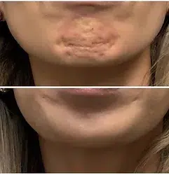 Chin before and after botox treatment at Revenge MD.