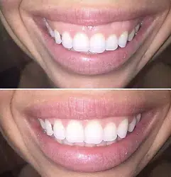 Woman's gummy smile reduced showing before and after results.
