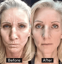 Woman looking significantly younger showing her before and after botox anti aging treatment.