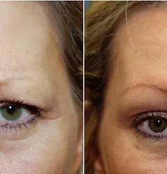 Woman's dysport before and after results.