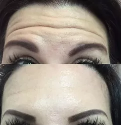 Woman's dysport before and after results.