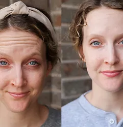 Woman's dysport before and after results.