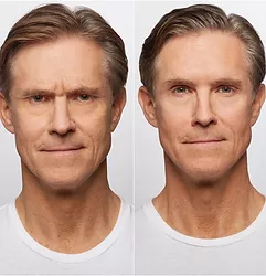 Man's dysport before and after results.