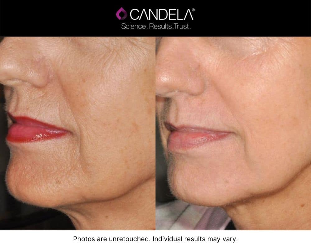 Woman's results Before and after IPL Photofacial.