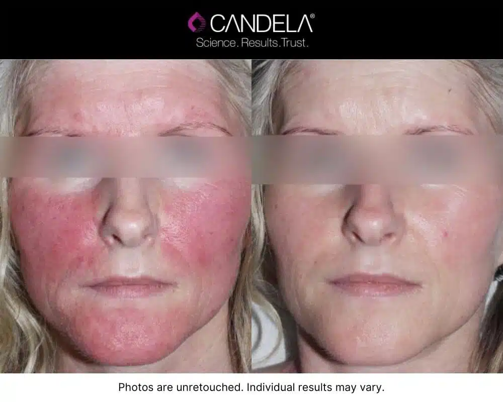 Woman with red skin blemishes Before and clarified skin tone after IPL Photofacial treatment.