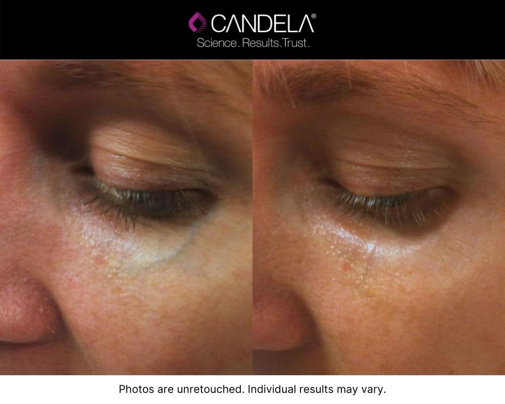 Before and after IPL Photofacial treatment improving skin tone and veins.
