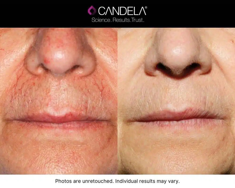Before and after IPL Photofacial treatment results on the upper lip and mouth.