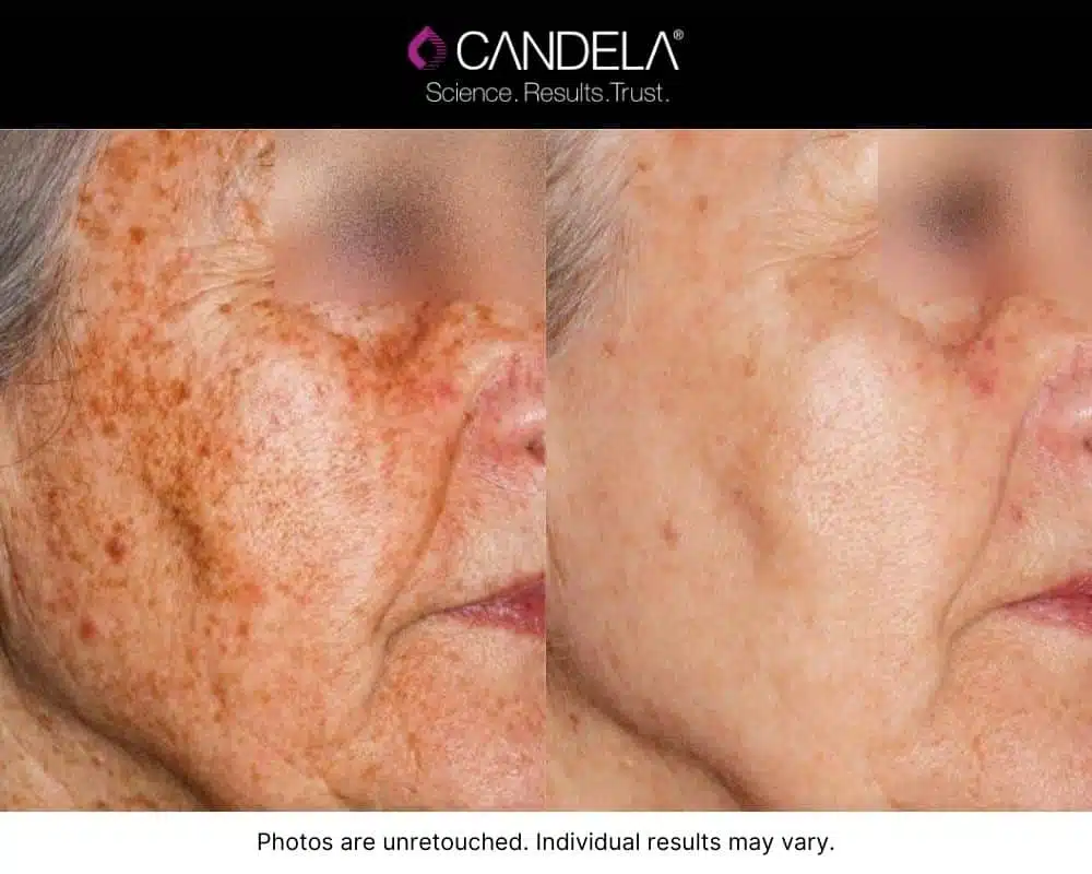 Before and after IPL Photofacial showing improved age spots.