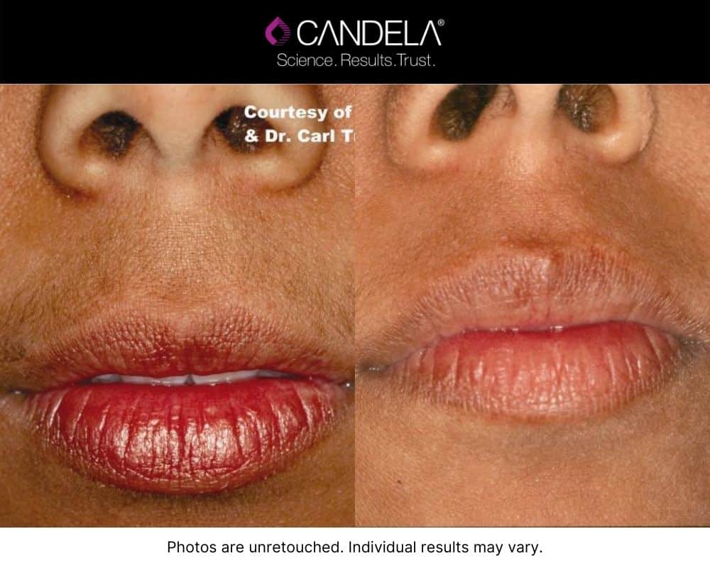 Lip area before and after IPL Photofacial.