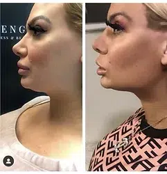 Woman's side profile showing improved lifted appearance without surgery before and after results of PDO Threads.