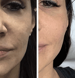 Woman's mouth area before and after PDO threads lift treatment.