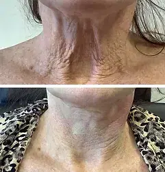 Neck area before and after PDO threads results showing significant improvement.