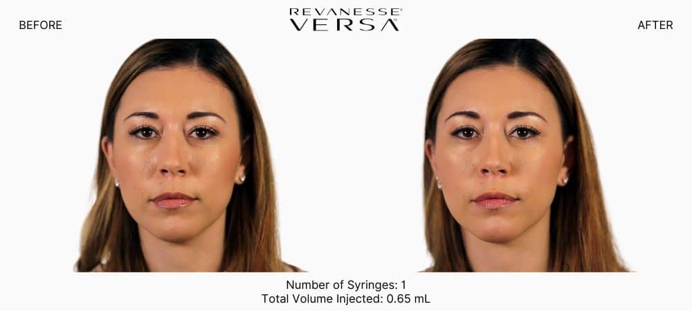 Woman's before and after revanesse versa dermal fillers injectable treatment.