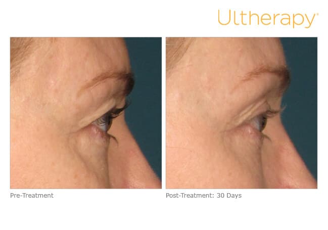 Ultherapy Before and After Revenge MD Las Vegas and Reno, NV (2)