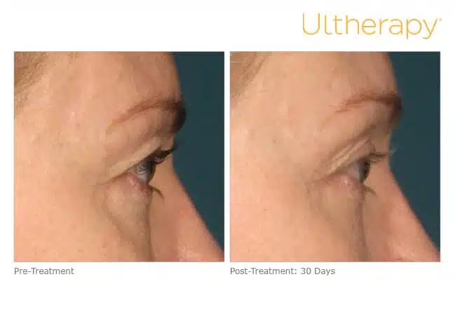 Ultherapy before and after results in Reno.