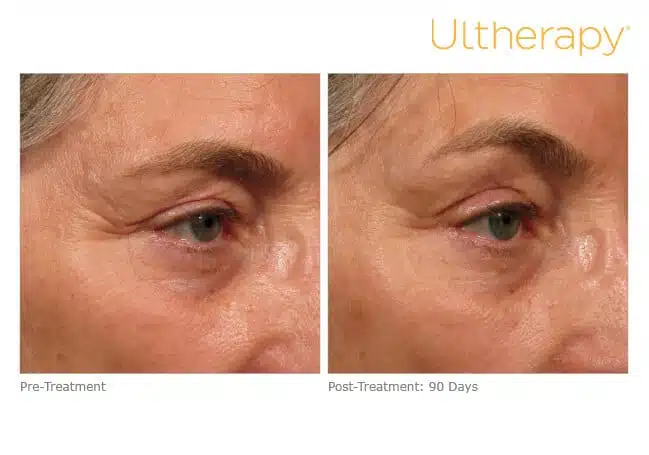 Ultherapy before and after results in Reno.