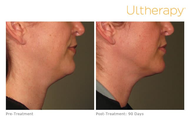 Ultherapy Before and After Revenge MD Las Vegas and Reno, NV (6)