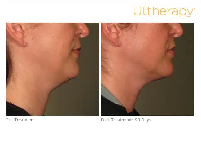 Ultherapy before and after results in Reno.