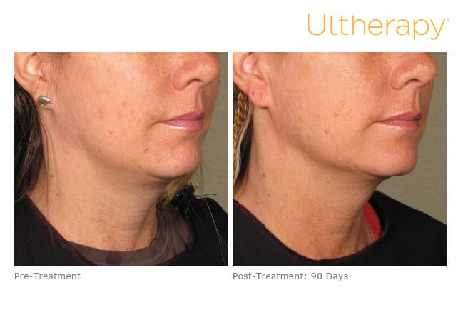 Ultherapy before and after results in Reno.