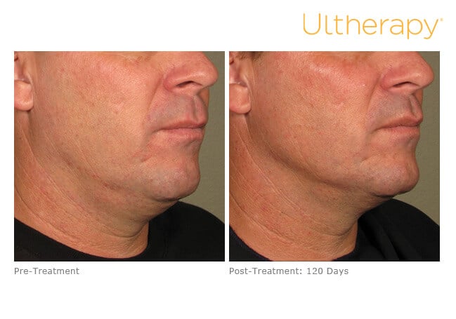 Ultherapy before and after results in Reno.