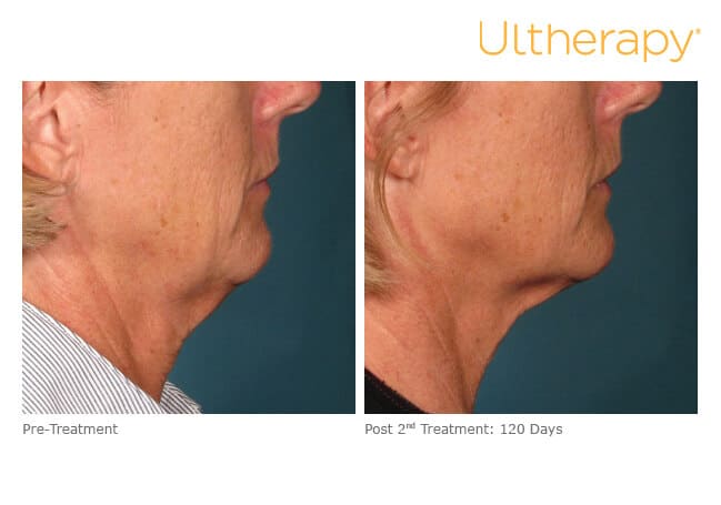 Ultherapy Before and After Revenge MD Las Vegas and Reno, NV