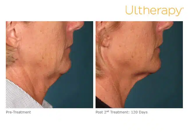 Ultherapy before and after results in Reno.