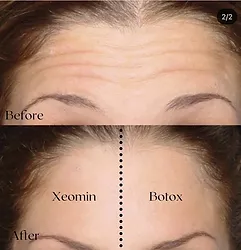 Xeomin Before and After Revenge MD Las Vegas and Reno Nevada (2)