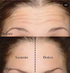 Woman's xeomin before and after results.