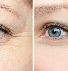 Woman's xeomin before and after results.