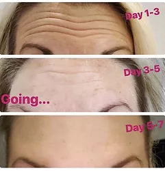 Woman's xeomin before and after results.