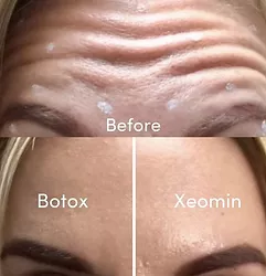 Woman's xeomin before and after results.