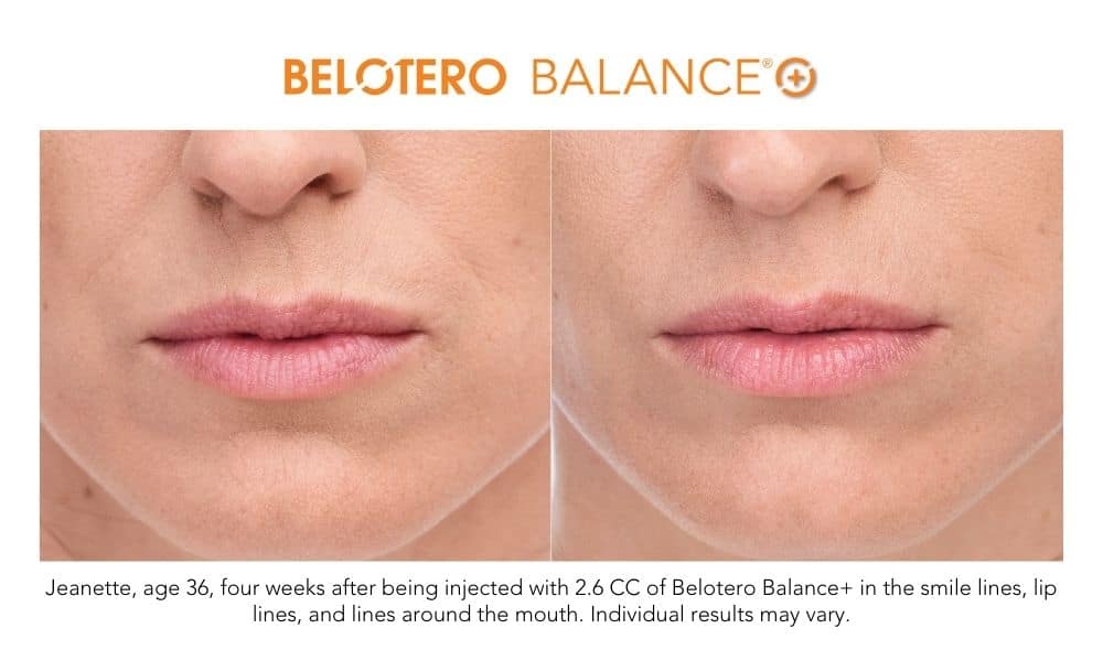 Before and after photos showing a woman's lips with fine lines before and smoother, less wrinkled skin after Belotero dermal filler treatment at Revenge MD.