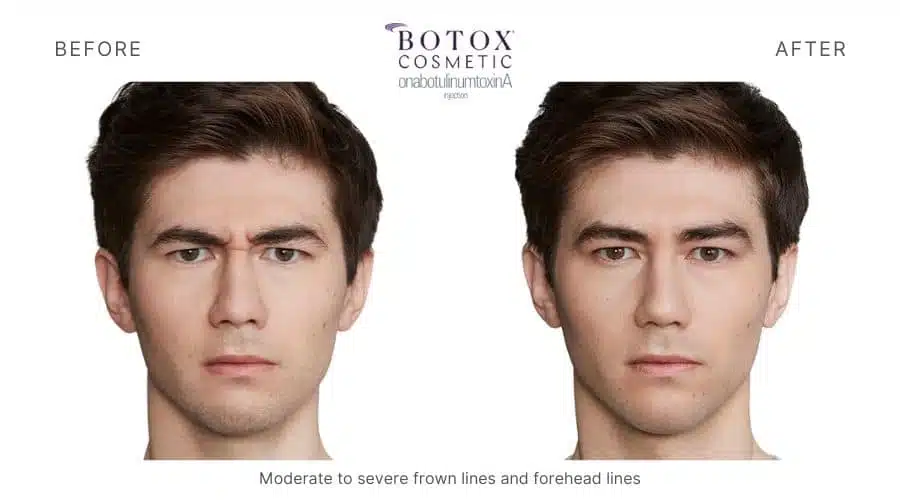 Man's facial expression before and after Botox treatment, a service offered at Revenge MD in Las Vegas and Reno, NV.