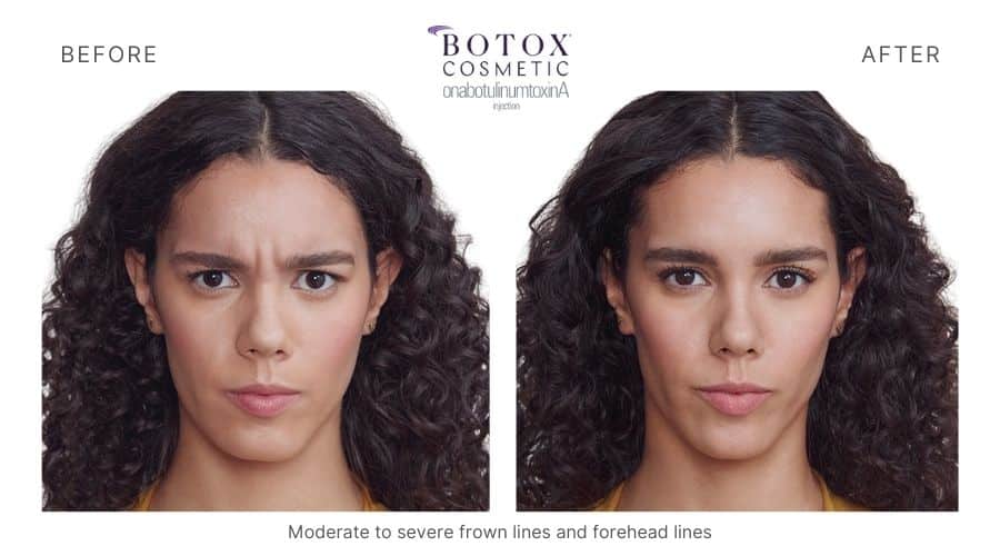 Woman's facial expression before and after Botox treatment.
