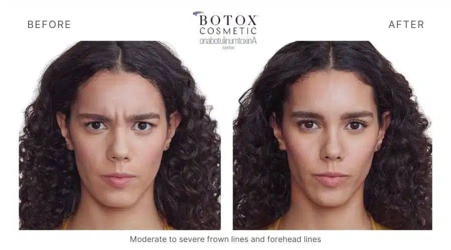 Woman's facial expression before and after Botox treatment, a service offered at Revenge MD in Las Vegas and Reno, NV.