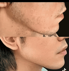 Before and after photos showing a man's jawline with less definition before and more definition and a more contoured jawline after dermal fillers treatment.