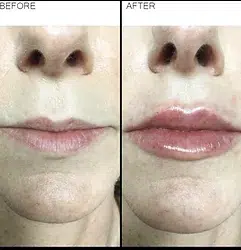 Before and after photo of a real Revenge MD patient showing thin lips before and fuller, more plump lips after dermal filler treatment.