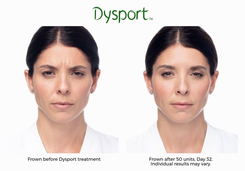 Dysport before and after results.