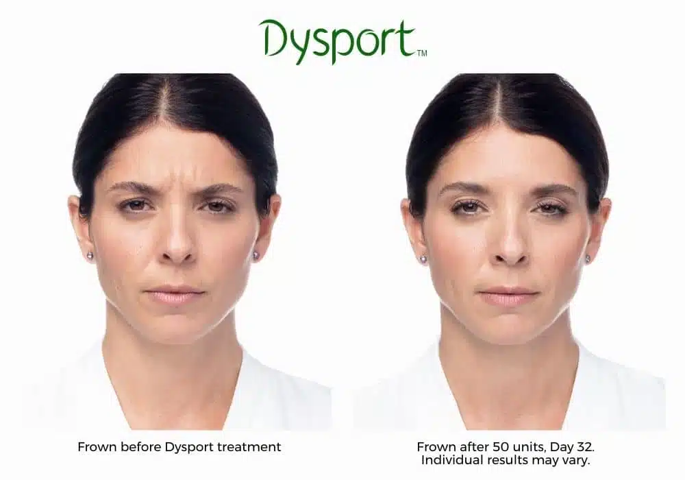 Dysport before and after results.