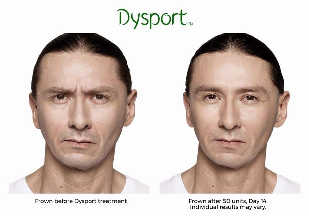 Man's dysport before and after results.