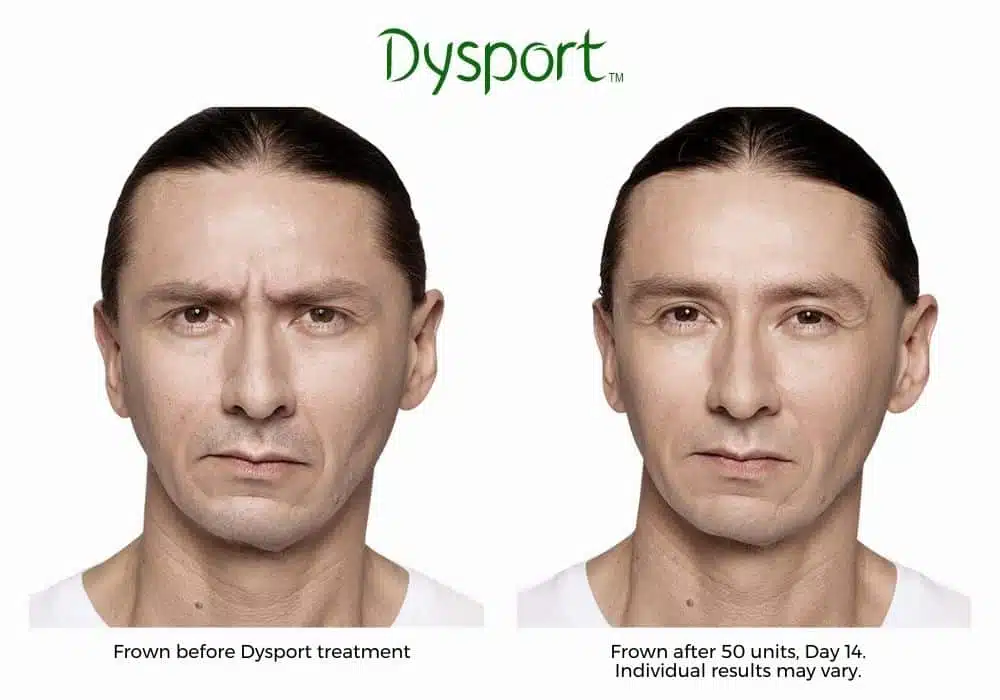 Man's dysport before and after results.