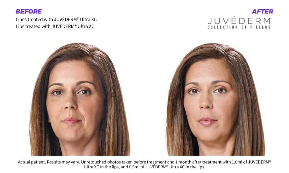 Woman's before and after Juvederm injectable dermal fillers treatment.