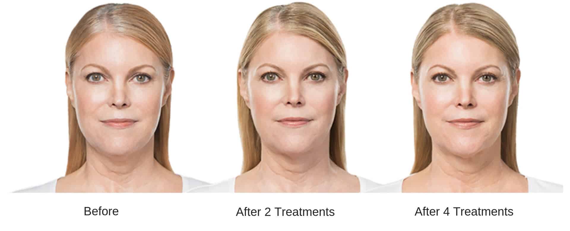 Woman's before and after results with Kybella.