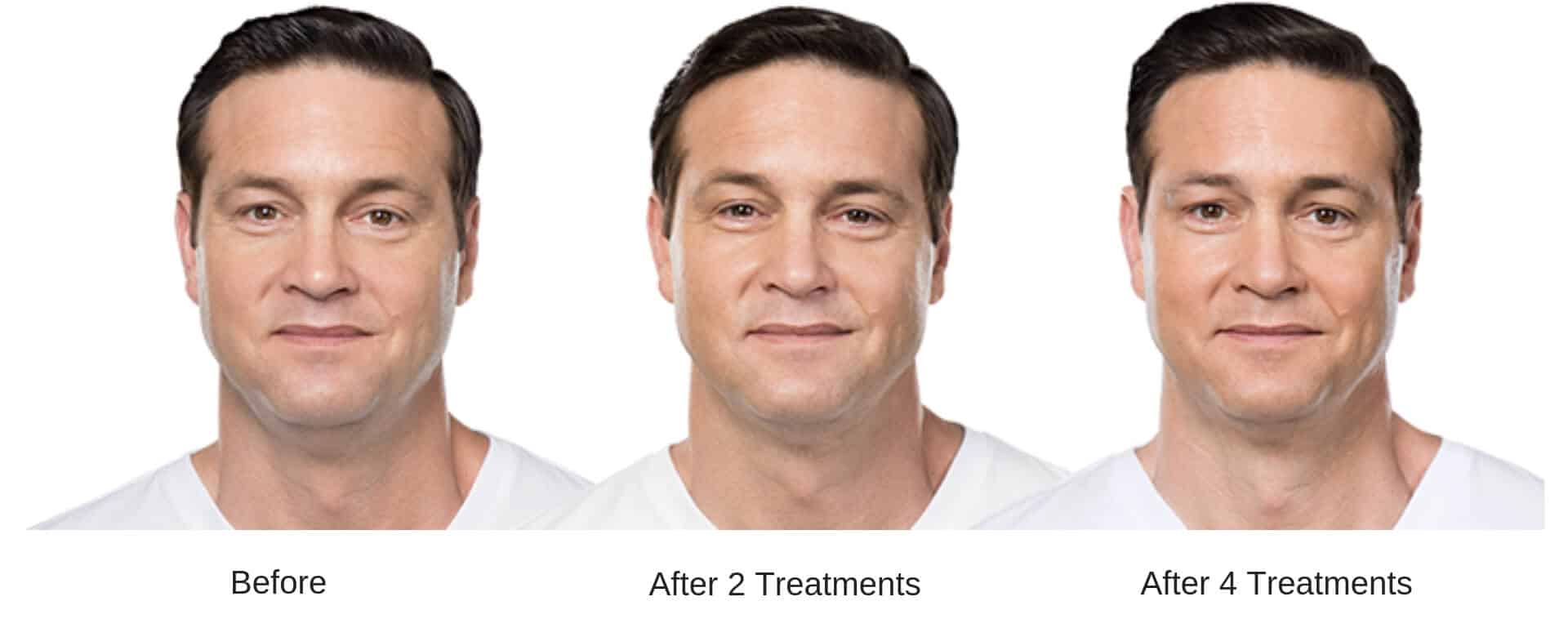 Man's before and after results with Kybella treatment.