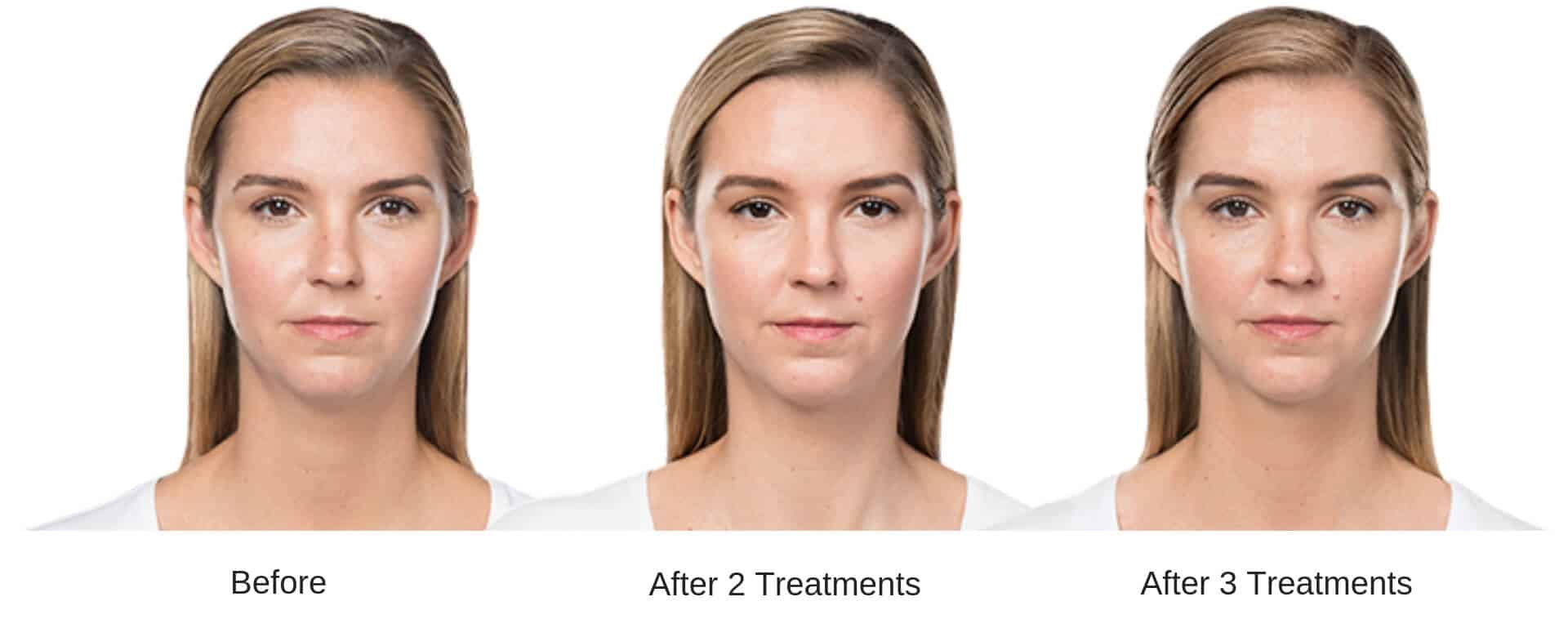 Woman's before and after results from Kybella treatment.