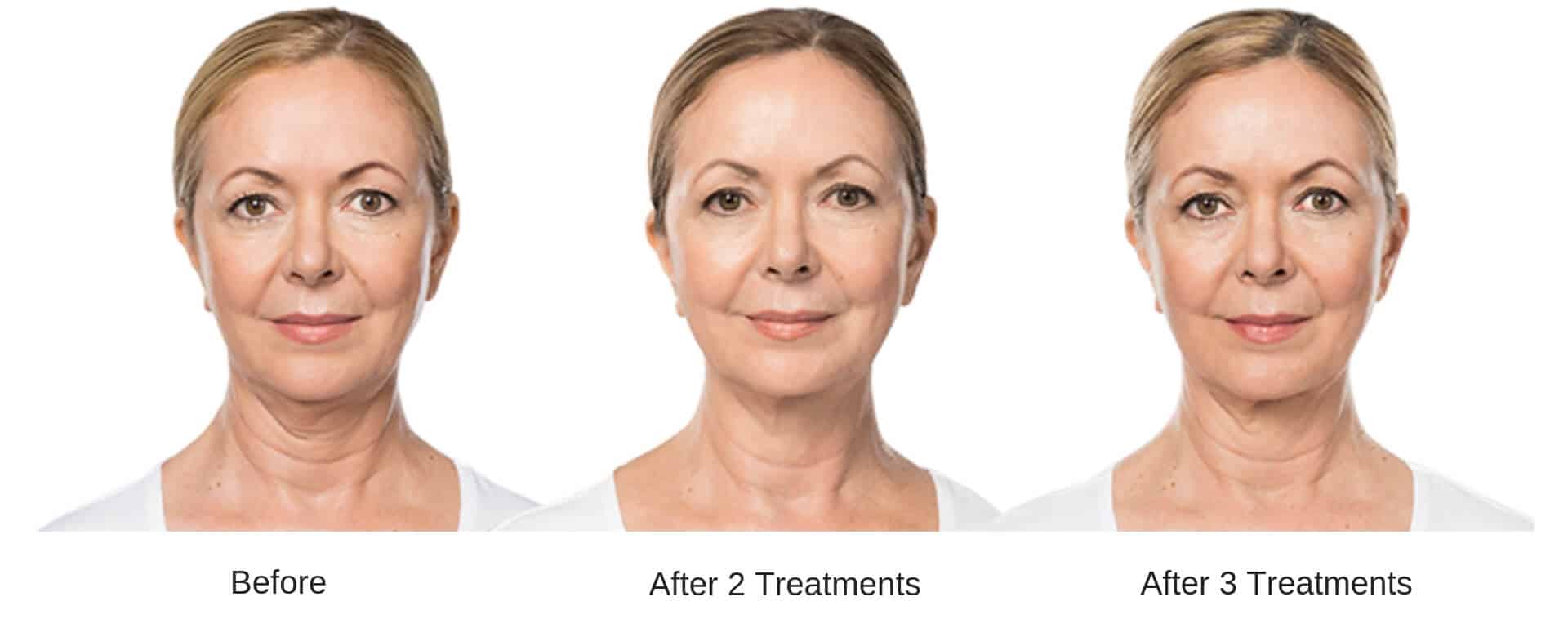 Woman's before and after results from kybella.