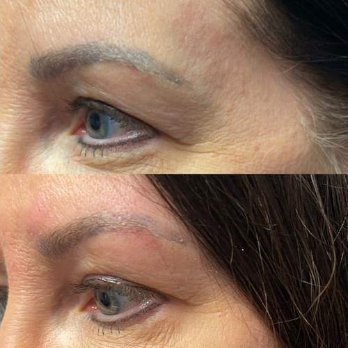 Woman's eyes looking lifted showing before and after result with PDO Threads.