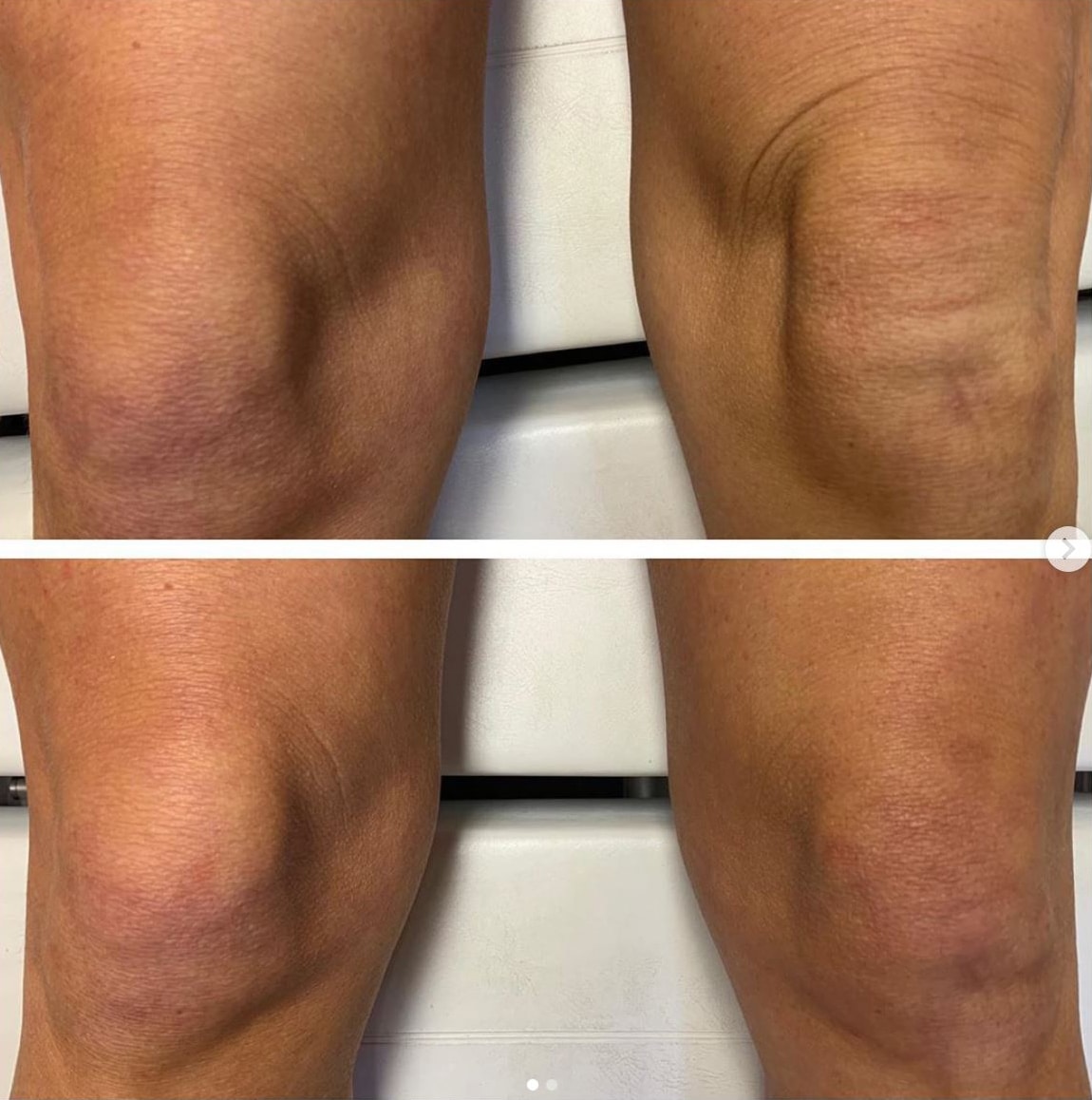 Knee wrinkles lifted with pdo threads.